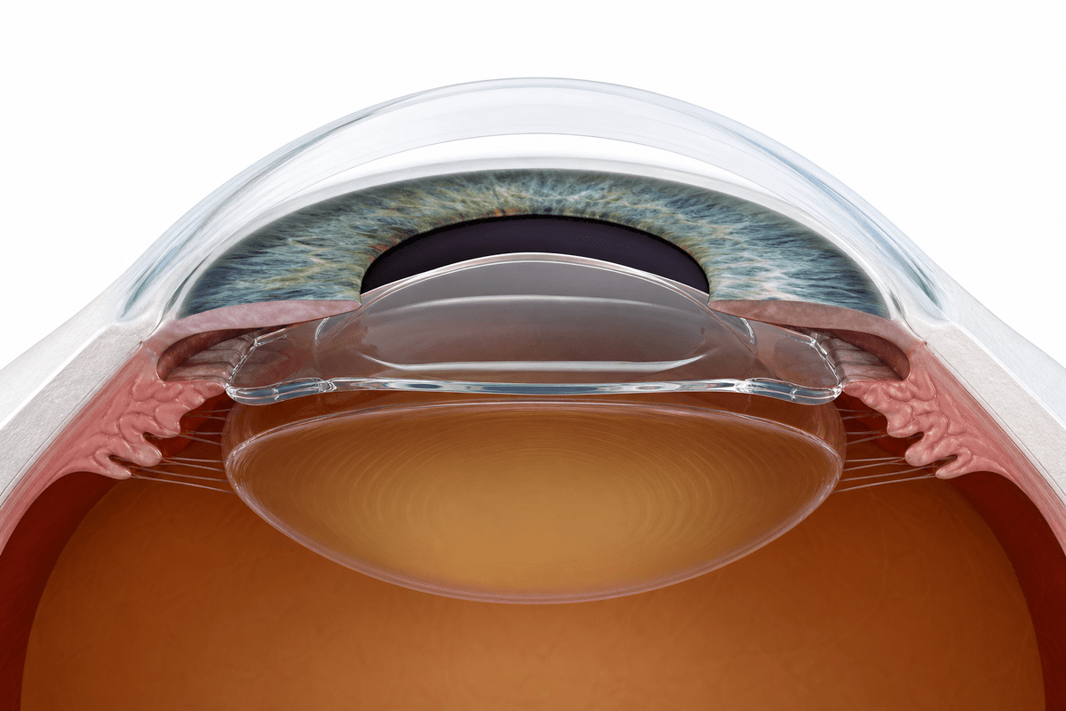 Implantable Collamer Lens (ICL)